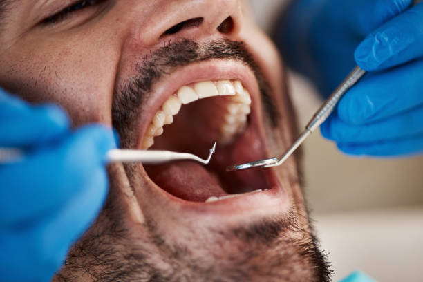 Best Dentist for Tooth Abscess  in Centerville, CA