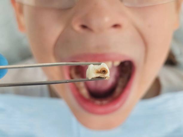Best Root Canal Emergency Dentist  in Centerville, CA